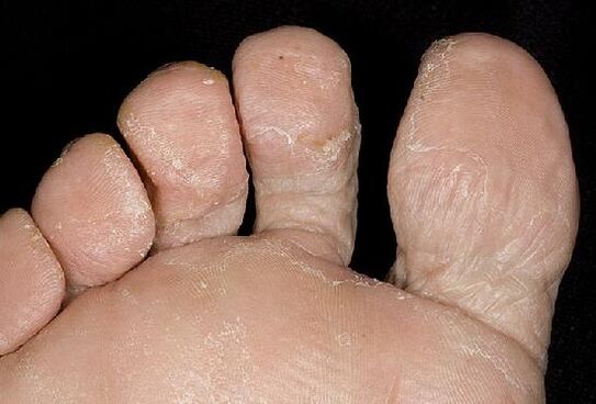 Manifestationen einer Pilzinfektion an den Füßen. 