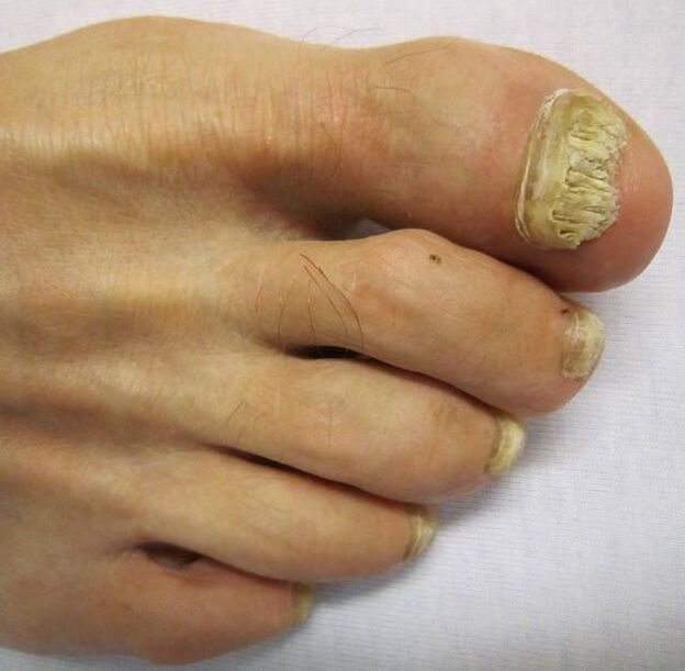 Schäden an den Nagelplatten