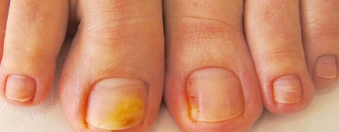 Nagelpilz