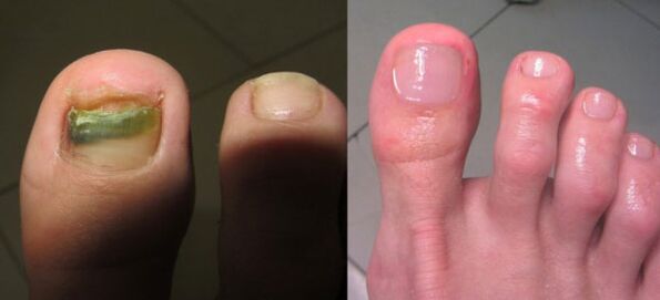 Behandlung von Nagelpilz