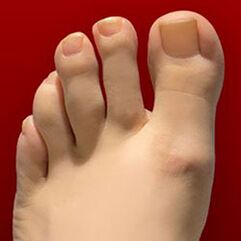 Nagelpilz