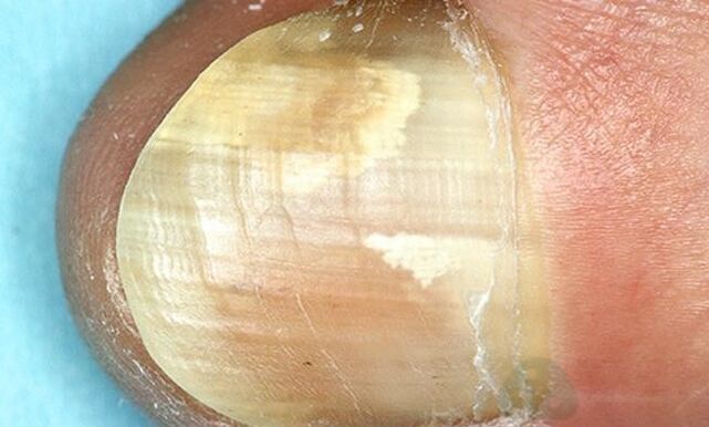 Behandlung von Fingerspitzenpilzen mit internen Wirkmedikamenten