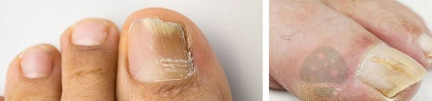 Der Nagelpilz des Daumens am Bein