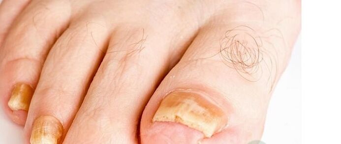 Sorten des Fingersnagelpilzes