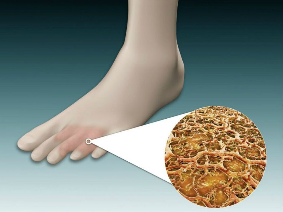 Rötung der Haut zwischen und in der Nähe der Zehen mit intertriginösem Pilz. 